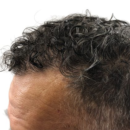 Hair Transplants Before & After Patient #1264