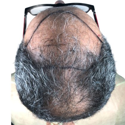 Hair Transplants Before & After Patient #1264
