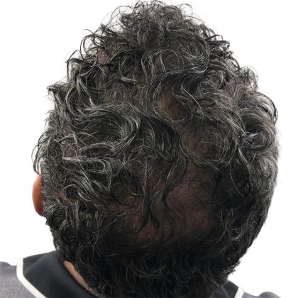Hair Transplants Before & After Patient #1264