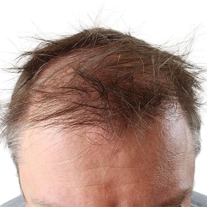 Hair Transplants Before & After Patient #1265