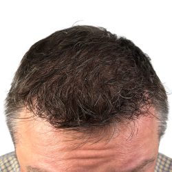 Hair Transplants Before & After Patient #1265