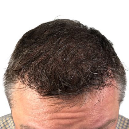 Hair Transplants Before & After Patient #1265