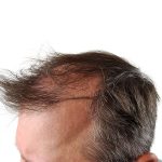 Hair Transplants Before & After Patient #1265