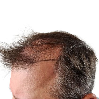 Hair Transplants Before & After Patient #1265