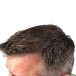Hair Transplants Before & After Patient #1265