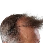 Hair Transplants Before & After Patient #1265