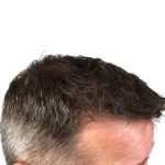 Hair Transplants Before & After Patient #1265