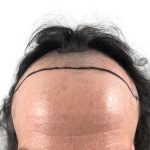 Hair Transplants Before & After Patient #1266