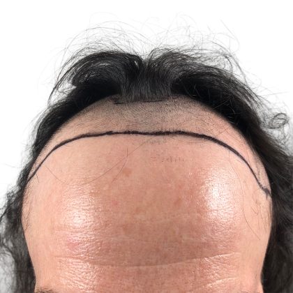 Hair Transplants Before & After Patient #1266