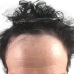 Hair Transplants Before & After Patient #1266