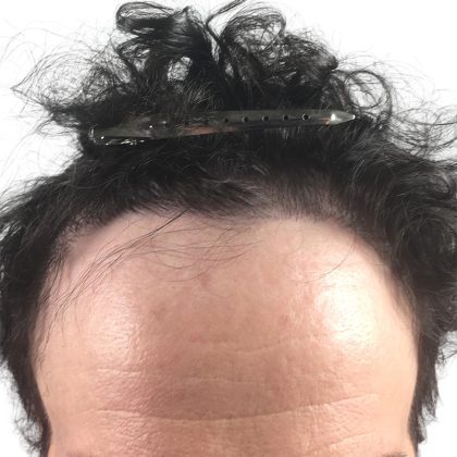 Hair Transplants Before & After Patient #1266