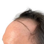 Hair Transplants Before & After Patient #1266