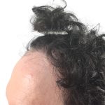 Hair Transplants Before & After Patient #1266