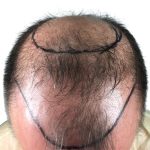 Hair Transplants Before & After Patient #1267