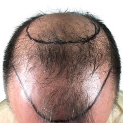 Hair Transplants Before & After Patient #1267
