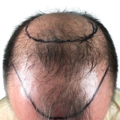 Hair Transplants Before & After Patient #1267