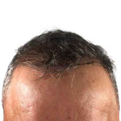 Hair Transplants Before & After Patient #1268