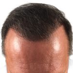 Hair Transplants Before & After Patient #1267