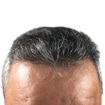 Hair Transplants Before & After Patient #1268