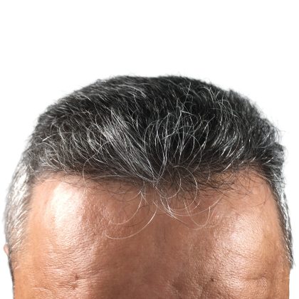 Hair Transplants Before & After Patient #1268
