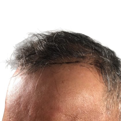 Hair Transplants Before & After Patient #1268