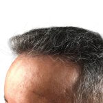 Hair Transplants Before & After Patient #1268
