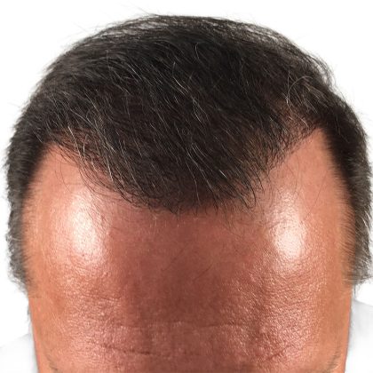 Hair Transplants Before & After Patient #1267