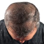 Hair Transplants Before & After Patient #1268