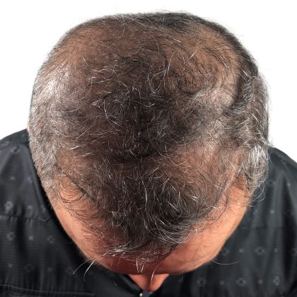 Hair Transplants Before & After Patient #1268