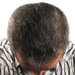 Hair Transplants Before & After Patient #1268