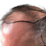 Hair Transplants Before & After Patient #1267