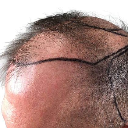 Hair Transplants Before & After Patient #1267