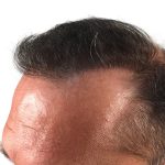 Hair Transplants Before & After Patient #1267