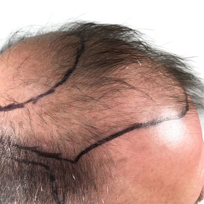 Hair Transplants Before & After Patient #1267