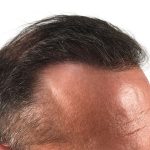 Hair Transplants Before & After Patient #1267