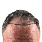 Hair Transplants Before & After Patient #1300
