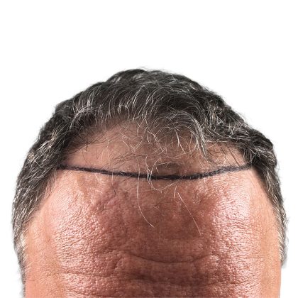 Hair Transplants Before & After Patient #1300