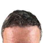 Hair Transplants Before & After Patient #1300