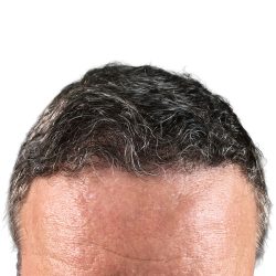 Hair Transplants Before & After Patient #1300