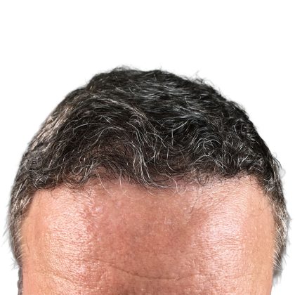 Hair Transplants Before & After Patient #1300