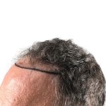 Hair Transplants Before & After Patient #1300