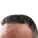 Hair Transplants Before & After Patient #1300