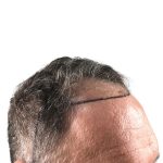Hair Transplants Before & After Patient #1300
