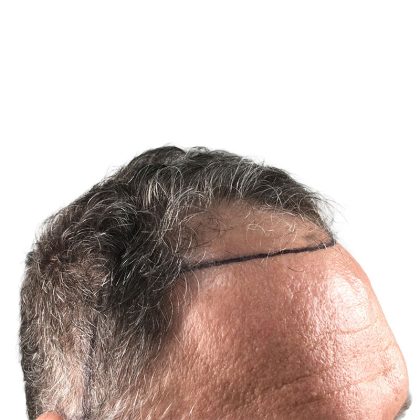 Hair Transplants Before & After Patient #1300