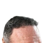 Hair Transplants Before & After Patient #1300