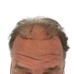 Hair Transplants Before & After Patient #1301