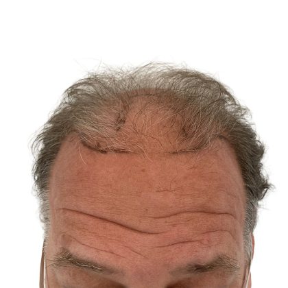 Hair Transplants Before & After Patient #1301