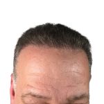 Hair Transplants Before & After Patient #1301