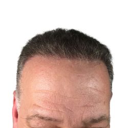 Hair Transplants Before & After Patient #1301