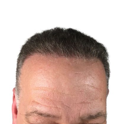 Hair Transplants Before & After Patient #1301